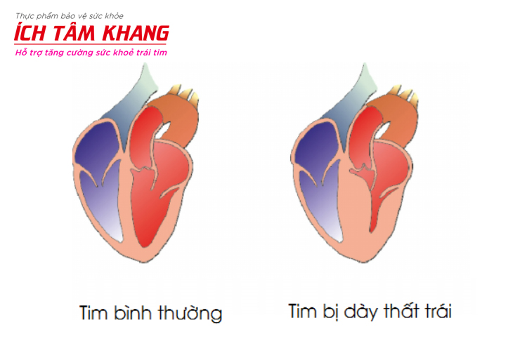 Buồng tim bị dày thất trái (bên phải) và buồng tim khỏe mạch (bên trái)